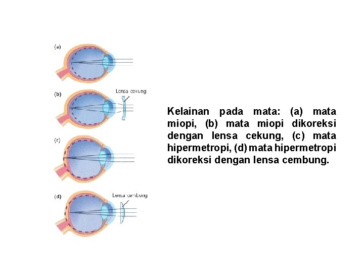 Kelainan pada mata: (a) mata miopi, (b) mata miopi dikoreksi dengan lensa cekung, (c)