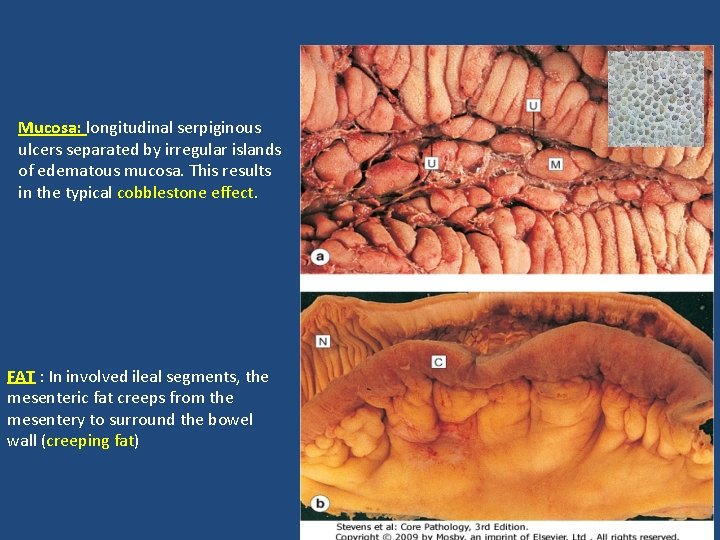Mucosa: longitudinal serpiginous ulcers separated by irregular islands of edematous mucosa. This results in