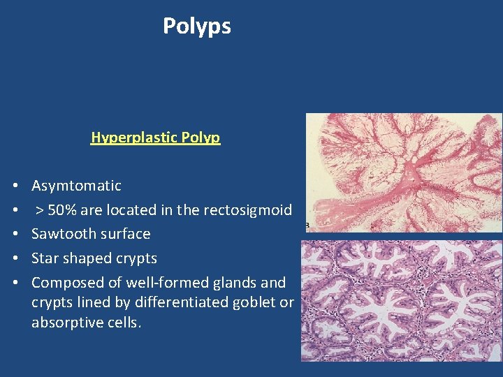 Polyps Hyperplastic Polyp • • • Asymtomatic > 50% are located in the rectosigmoid