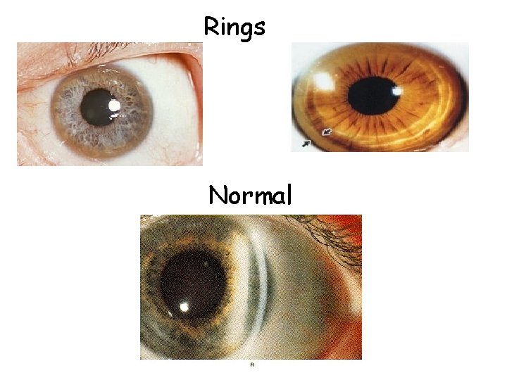 Rings Normal 