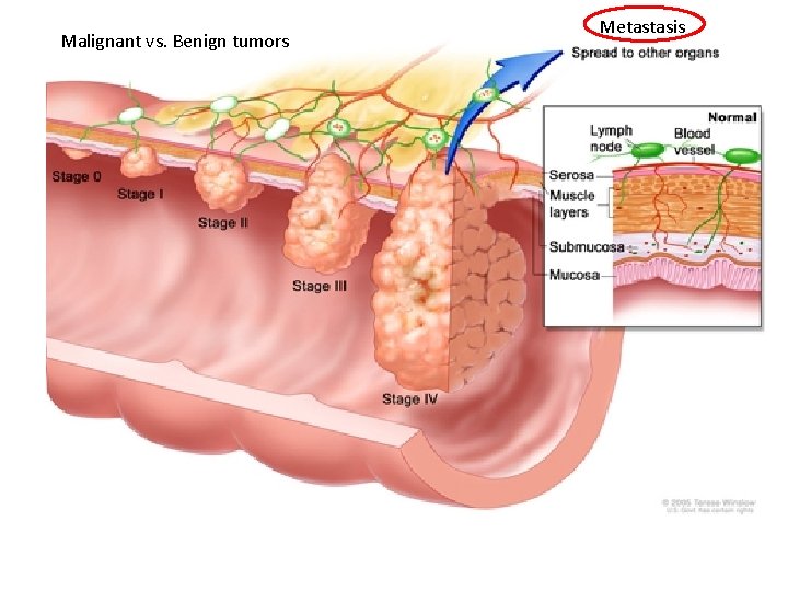 Malignant vs. Benign tumors Metastasis 