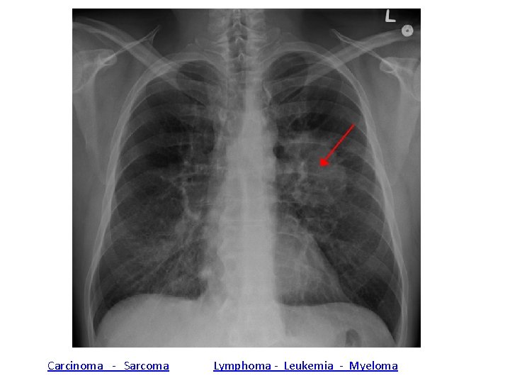 Carcinoma - Sarcoma Lymphoma - Leukemia - Myeloma 