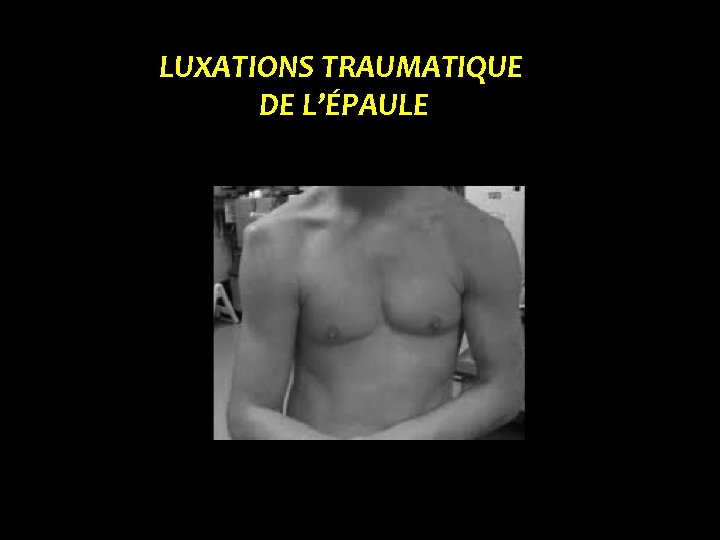 LUXATIONS TRAUMATIQUE DE L’ÉPAULE 