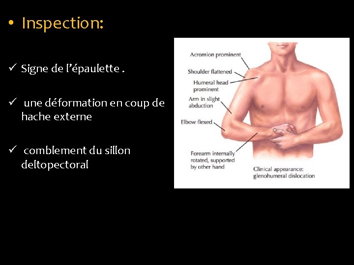  • Inspection: ü Signe de l’épaulette. ü une déformation en coup de hache