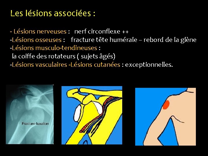 Les lésions associées : - Lésions nerveuses : nerf circonflexe ++ -Lésions osseuses :