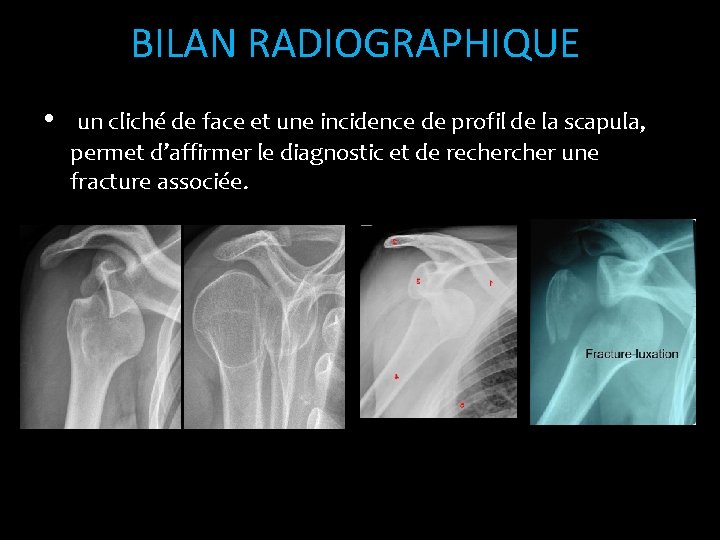 BILAN RADIOGRAPHIQUE • un cliché de face et une incidence de profil de la