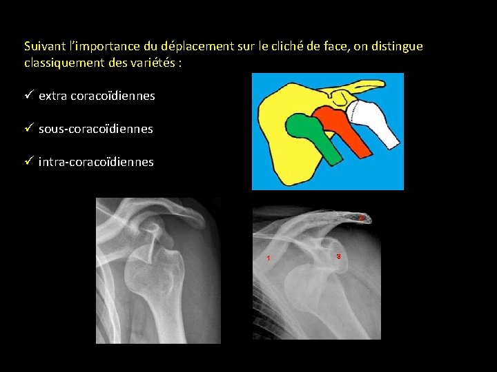 Suivant l’importance du déplacement sur le cliché de face, on distingue classiquement des variétés Suivant l’importance du déplacement sur le cliché de face, on distingue classiquement des variétés