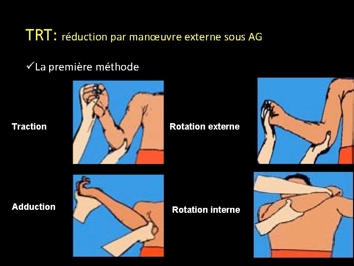 TRT: réduction par manœuvre externe sous AG üLa première méthode Traction Adduction Rotation externe