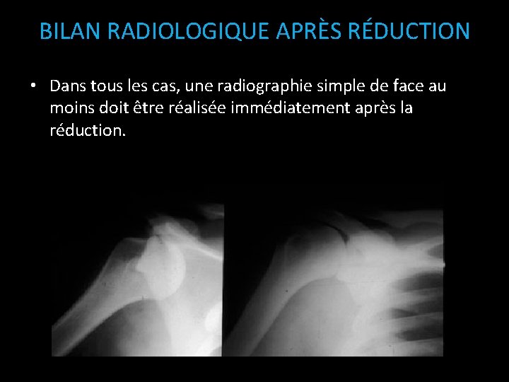 BILAN RADIOLOGIQUE APRÈS RÉDUCTION • Dans tous les cas, une radiographie simple de face