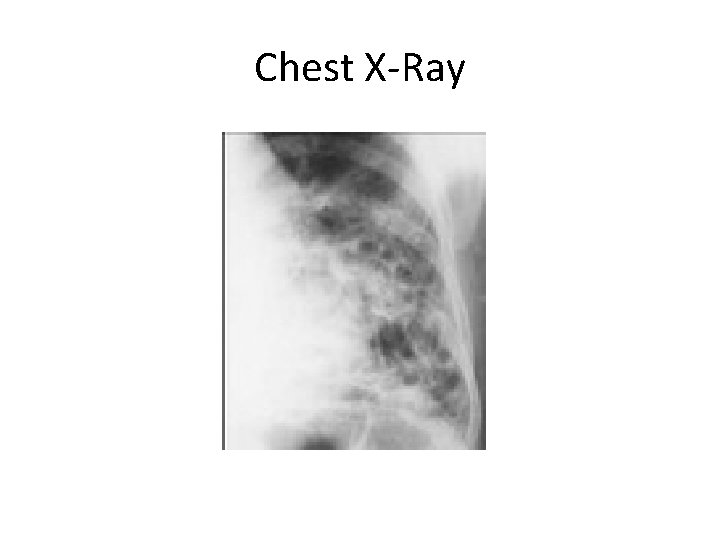 Chest X-Ray 