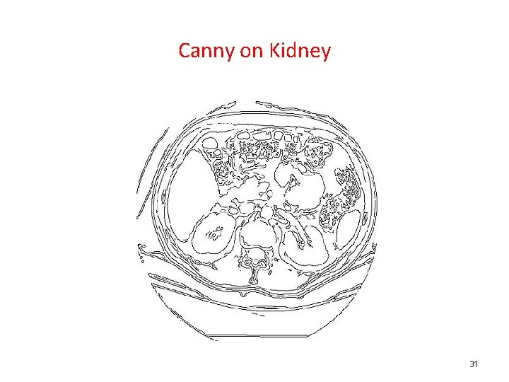 Canny on Kidney 31 
