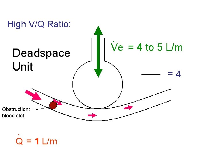 High V/Q Ratio: Deadspace Unit Obstruction: blood clot . Q = 1 L/m .