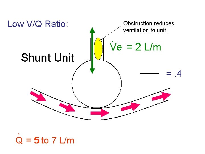 Low V/Q Ratio: Shunt Unit Obstruction reduces ventilation to unit. . Ve = 2