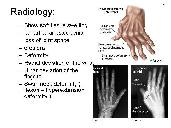 Radiology: – – – – Show soft tissue swelling, periarticular osteopenia, loss of joint