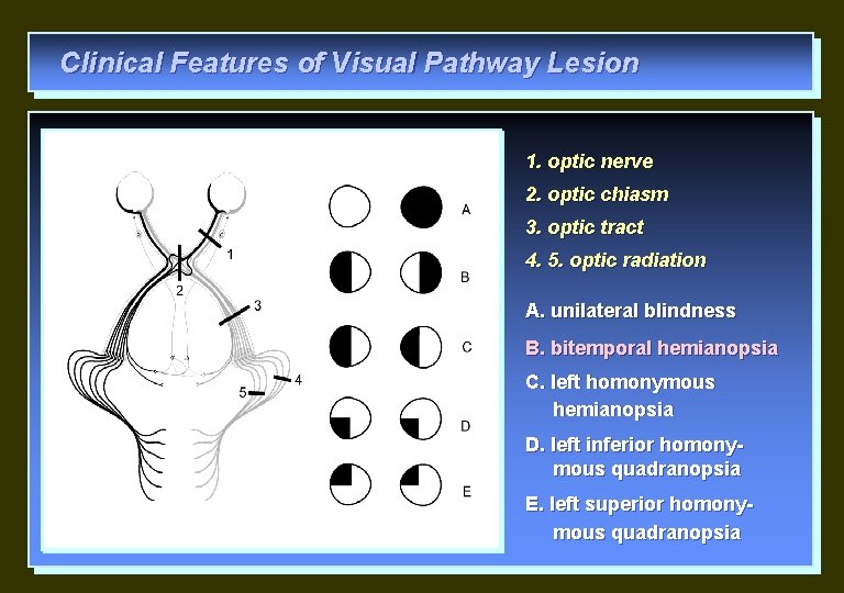 Clinical Features of Visual Pathway Lesion 1. optic nerve 2. optic chiasm 3. optic