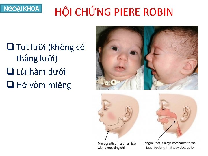 NGOẠI KHOA HỘI CHỨNG PIERE ROBIN q Tụt lưỡi (không có thắng lưỡi) q