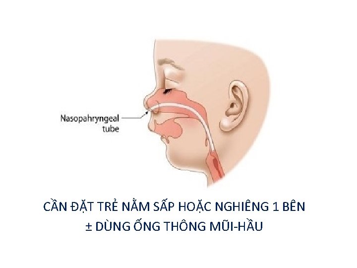 CẦN ĐẶT TRẺ NẰM SẤP HOẶC NGHIÊNG 1 BÊN ± DÙNG ỐNG THÔNG MŨI-HẦU