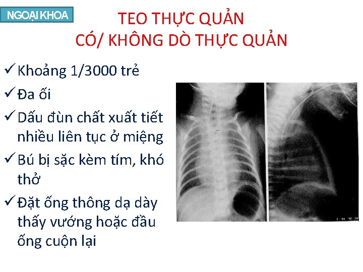 NGOẠI KHOA TEO THỰC QUẢN CÓ/ KHÔNG DÒ THỰC QUẢN Khoảng 1/3000 trẻ Đa