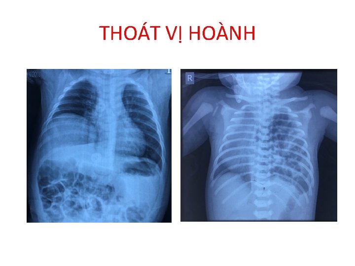 THOÁT VỊ HOÀNH 