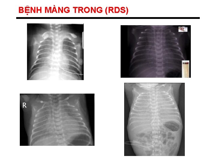 BỆNH MÀNG TRONG (RDS) 