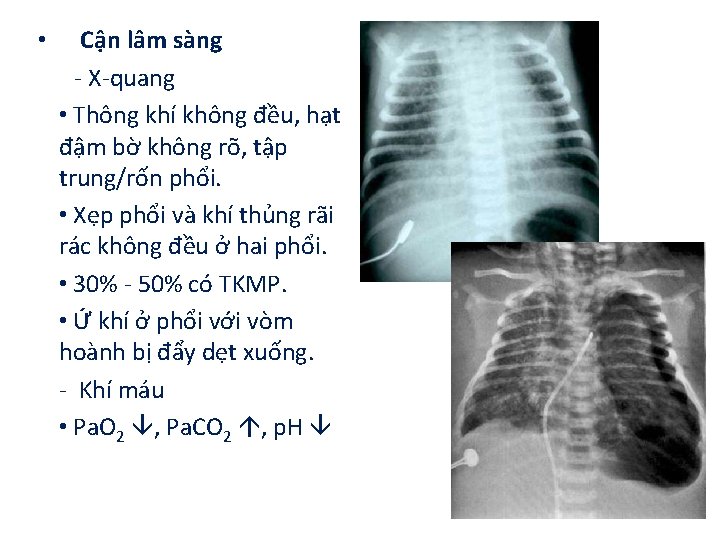  • Cận lâm sàng - X-quang • Thông khí không đều, hạt đậm