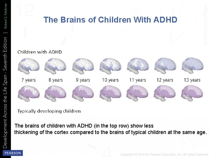 The Brains of Children With ADHD The brains of children with ADHD (in the