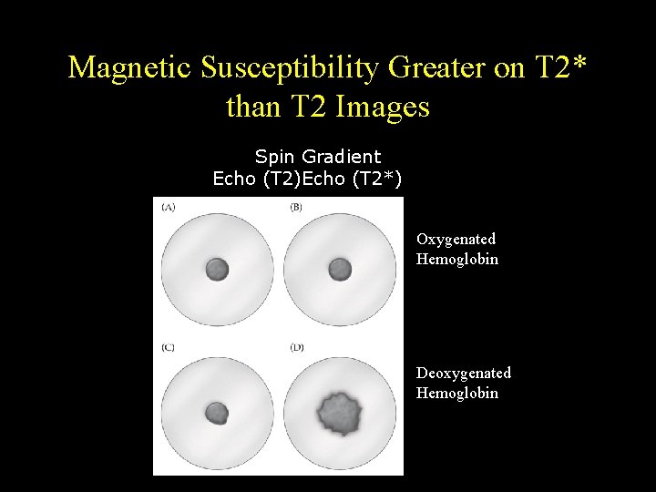 Magnetic Susceptibility Greater on T 2* than T 2 Images Spin Gradient Echo (T