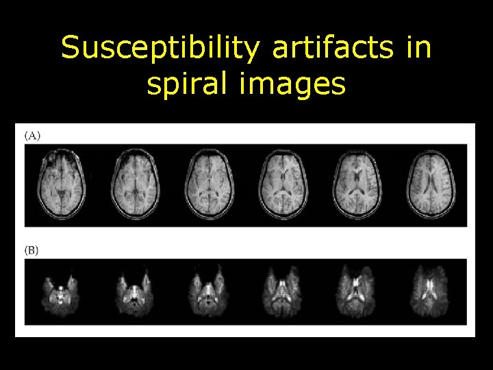 Susceptibility artifacts in spiral images 