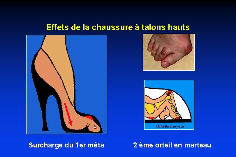 Effets de la chaussure à talons hauts Surcharge du 1 er méta 2 ème