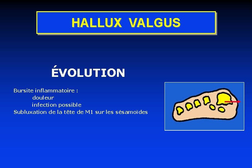 HALLUX VALGUS ÉVOLUTION Bursite inflammatoire : douleur infection possible Subluxation de la tête de