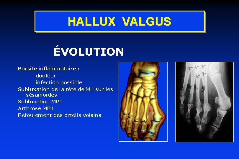 HALLUX VALGUS ÉVOLUTION Bursite inflammatoire : douleur infection possible Subluxation de la tête de