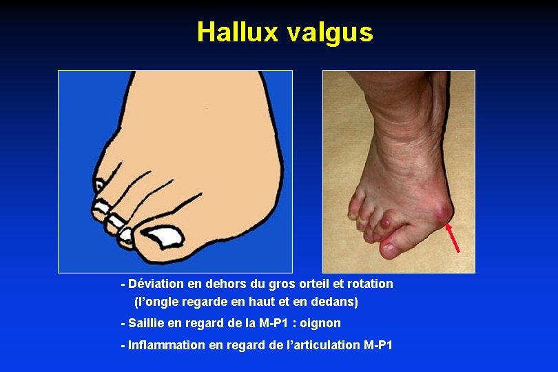 Hallux valgus - Déviation en dehors du gros orteil et rotation (l’ongle regarde en