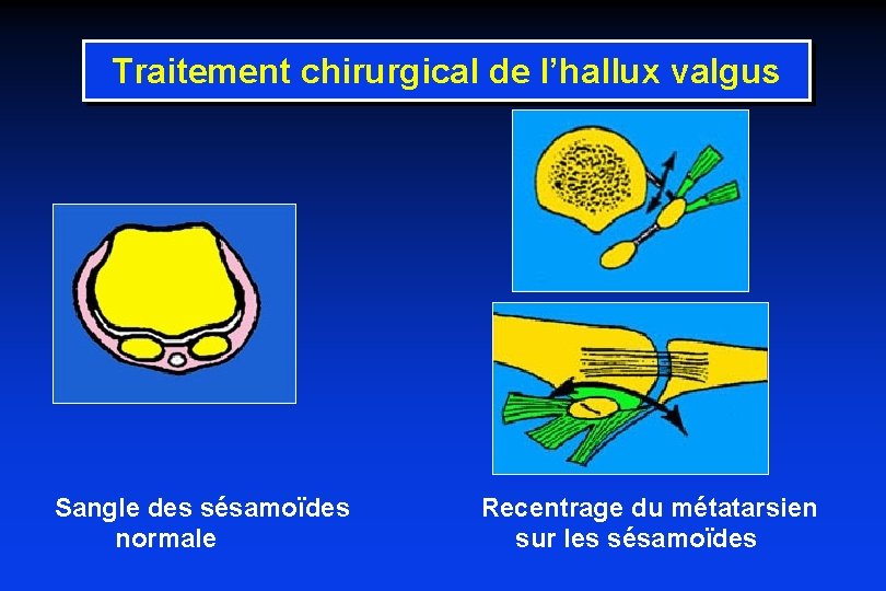 Traitement chirurgical de l’hallux valgus Sangle des sésamoïdes normale Recentrage du métatarsien sur les