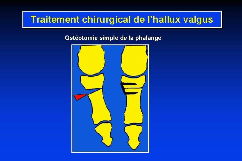 Traitement chirurgical de l’hallux valgus Ostéotomie simple de la phalange 