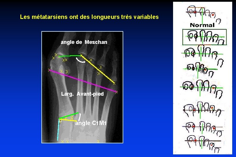 Les métatarsiens ont des longueurs très variables angle de Meschan Larg. Avant-pied angle C