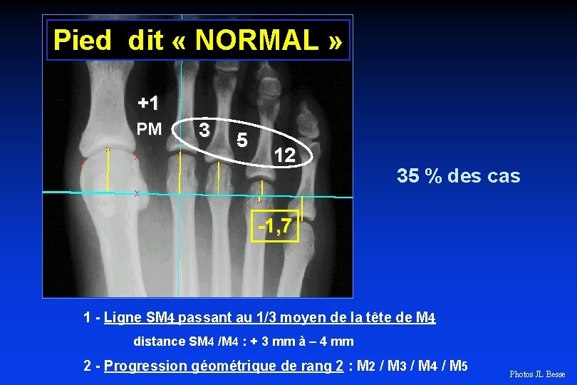 Pied dit « NORMAL » +1 PM 3 5 12 35 % des cas