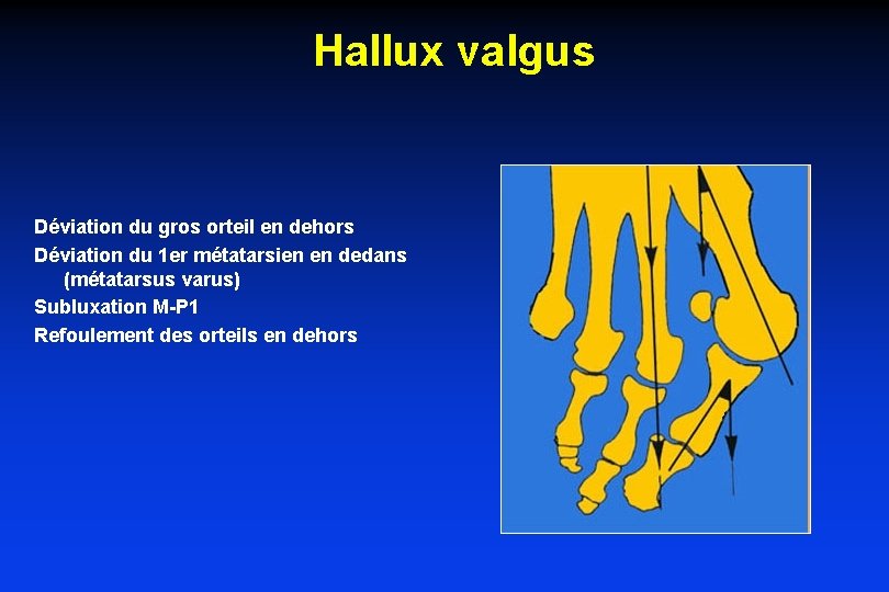 Hallux valgus Déviation du gros orteil en dehors Déviation du 1 er métatarsien en