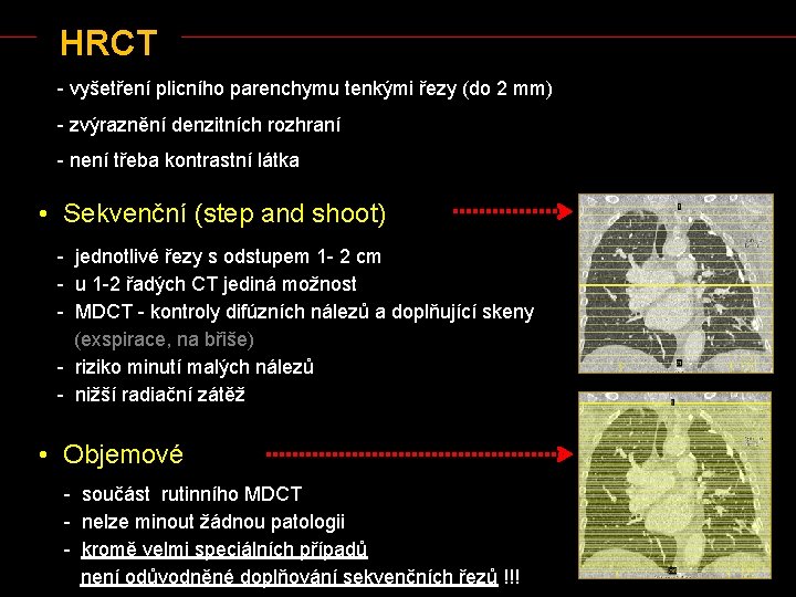 HRCT - vyšetření plicního parenchymu tenkými řezy (do 2 mm) - zvýraznění denzitních rozhraní