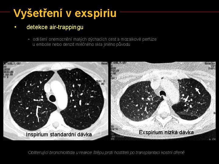 Vyšetření v exspiriu • detekce air-trappingu - odlišení onemocnění malých dýchacích cest a mozaikové