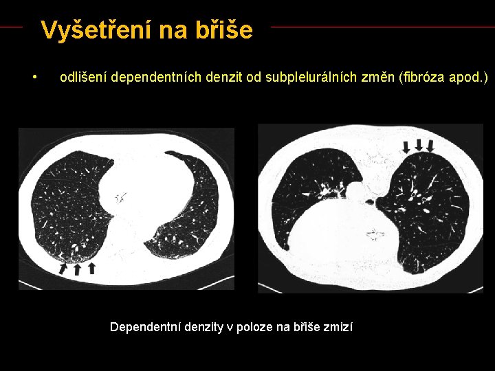 Vyšetření na břiše • odlišení dependentních denzit od subplelurálních změn (fibróza apod. ) Dependentní