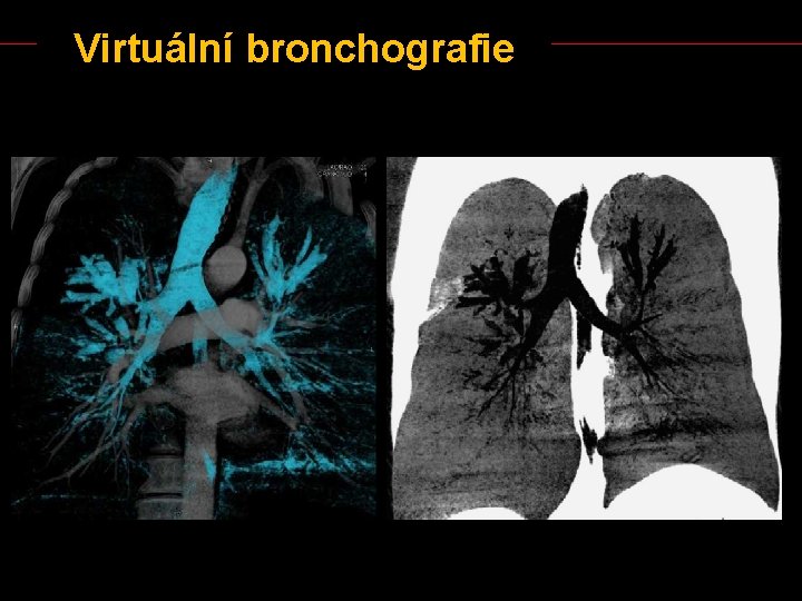 Virtuální bronchografie 