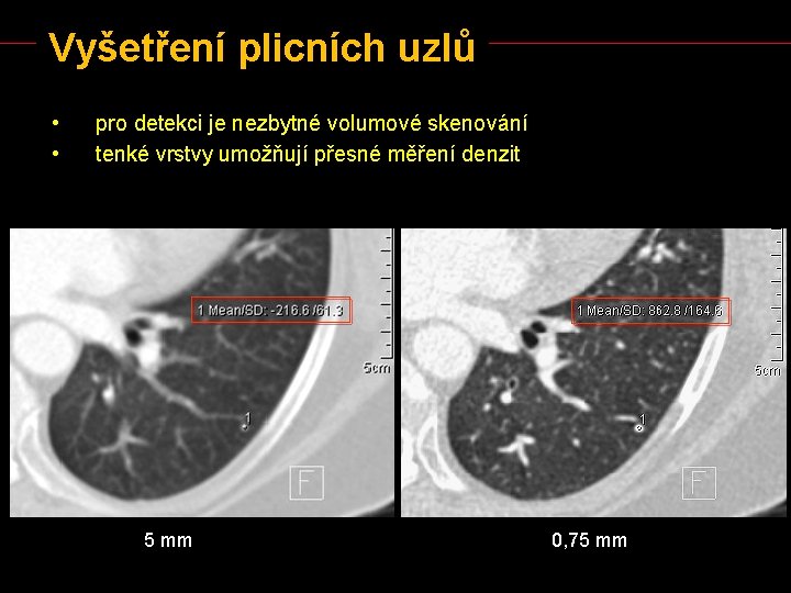 Vyšetření plicních uzlů • • pro detekci je nezbytné volumové skenování tenké vrstvy umožňují