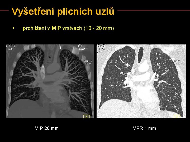 Vyšetření plicních uzlů • prohlížení v MIP vrstvách (10 - 20 mm) MIP 20