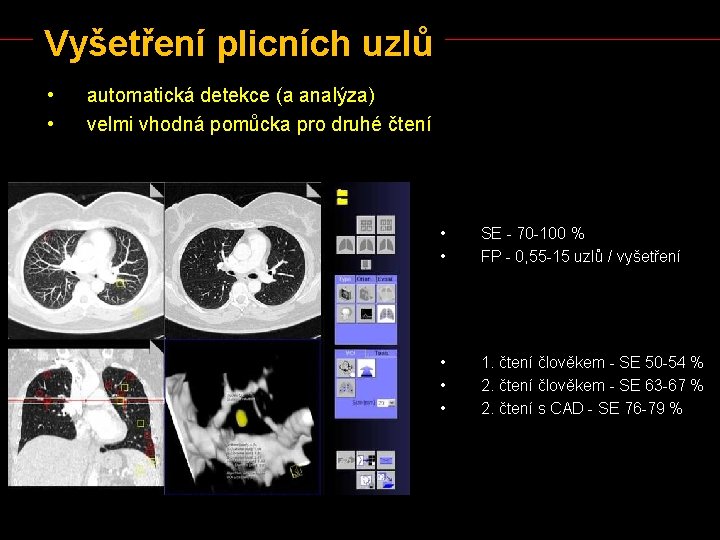 Vyšetření plicních uzlů • • automatická detekce (a analýza) velmi vhodná pomůcka pro druhé