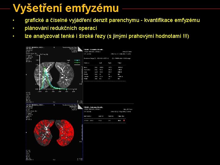 Vyšetření emfyzému • • • grafické a číselné vyjádření denzit parenchymu - kvantifikace emfyzému