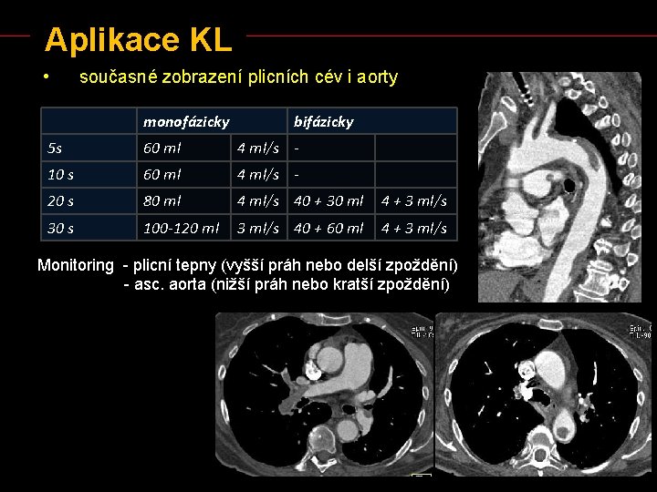 Aplikace KL • současné zobrazení plicních cév i aorty monofázicky bifázicky 5 s 60