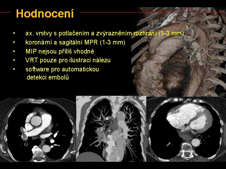 Hodnocení • • • ax. vrstvy s potlačením a zvýrazněním rozhraní (1 -3 mm)