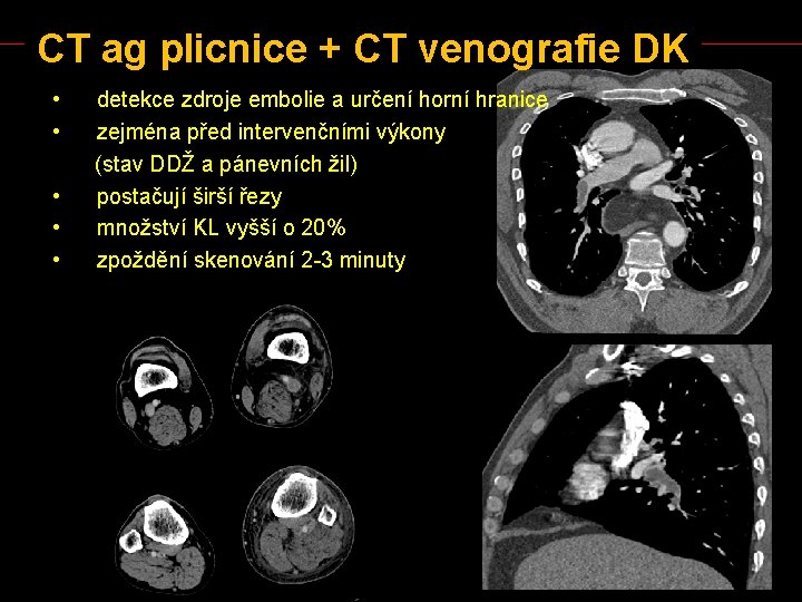 CT ag plicnice + CT venografie DK • • • detekce zdroje embolie a