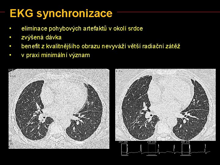 EKG synchronizace • • eliminace pohybových artefaktů v okolí srdce zvýšená dávka benefit z