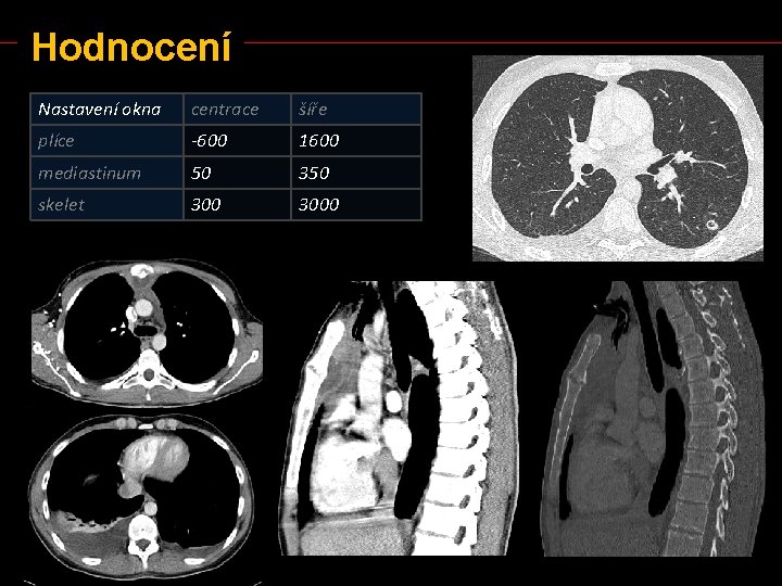 Hodnocení Nastavení okna centrace šíře plíce -600 1600 mediastinum 50 350 skelet 3000 